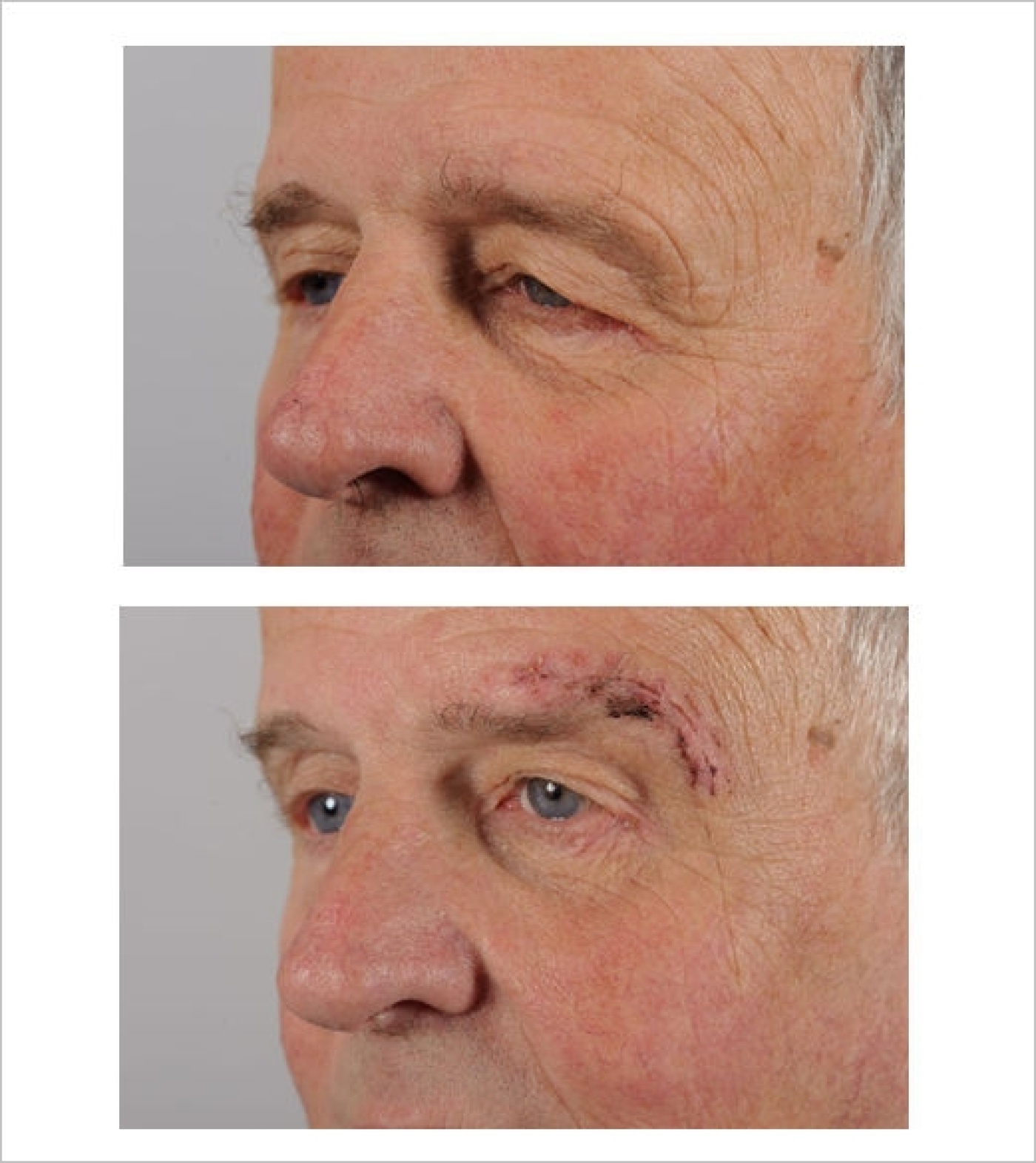 20190605-Wenkbrauwlift-rand.jpg 20190605-Wenkbrauwlift-rand.jpg